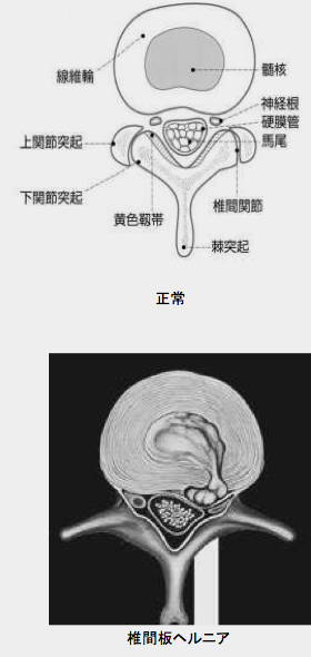 静岡市立清水病院 内視鏡下腰椎椎間板ヘルニア摘出術