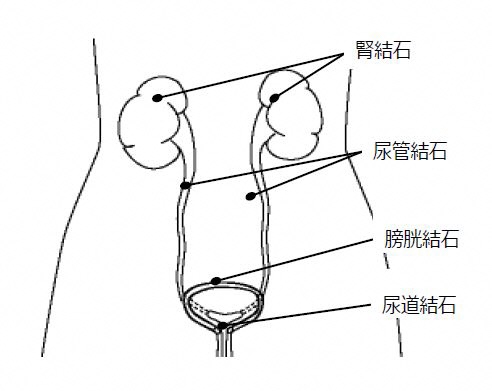 症状 結石 下腹部や腰に激痛が?!尿路結石の「痛み」の原因とメカニズム