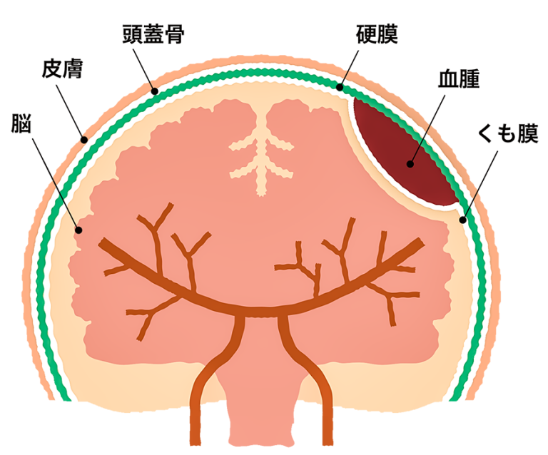 静岡市立清水病院 ｜ 慢性硬膜下血腫（まんせいこうまくかけっしゅ）
