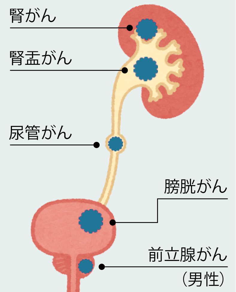 血尿がん _ 血尿 原因 _ 膀胱がん：[国立がん研究センター がん情報サービス 一般の方へ] – HUUILX