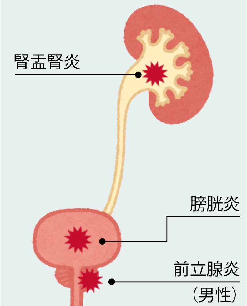 熱咳血尿 – 排尿困難 症状 発熱 _ 大人もかかる溶連菌の症状・検査・治療について – MLUWZ